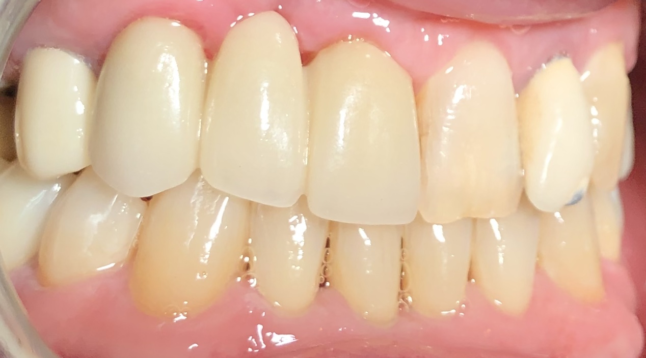 Smile gallery dentist image of dental patient upper crown post service