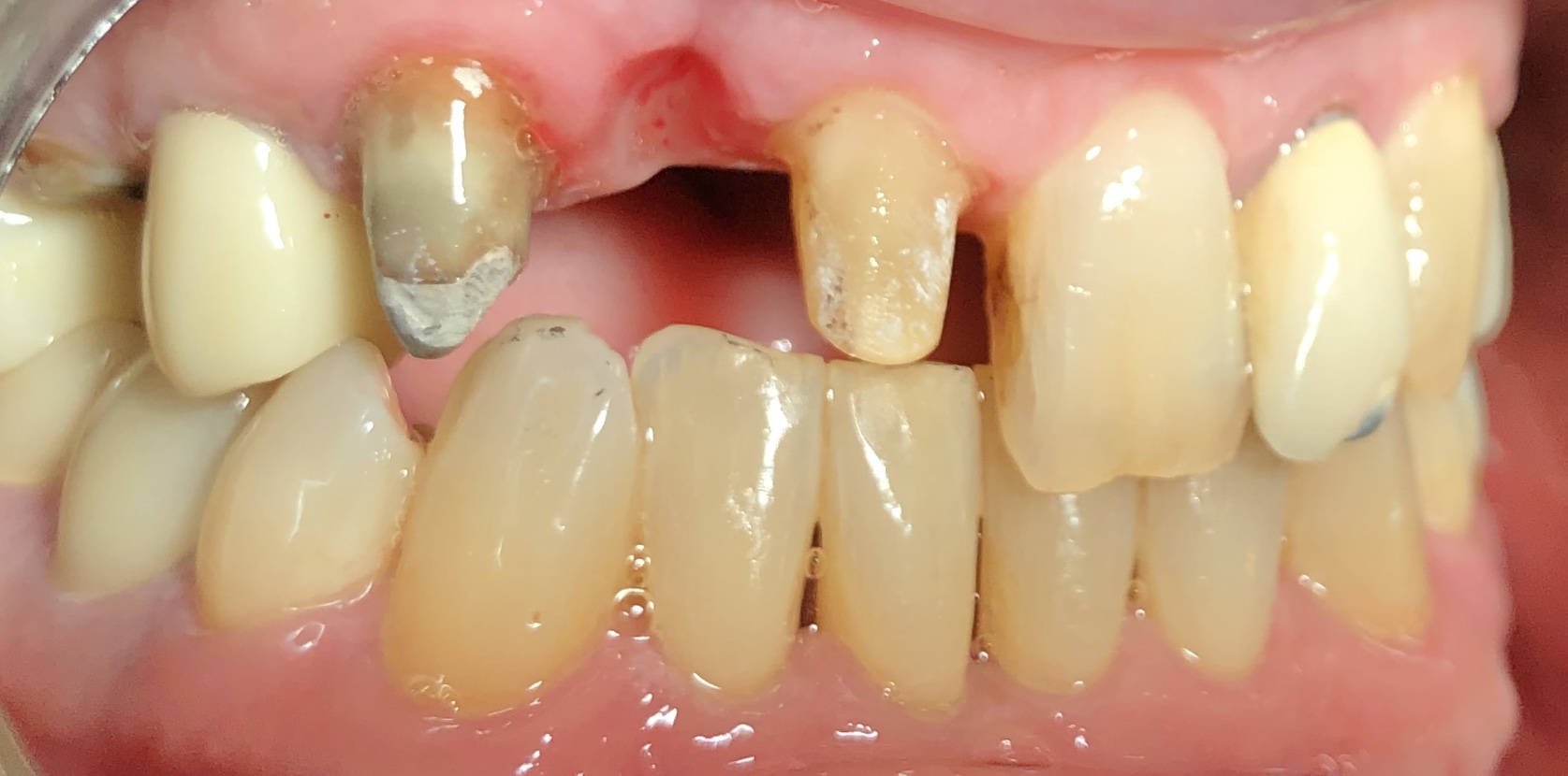 Smile gallery dentist image of dental patient upper crown pre service