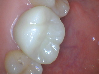Smile gallery dentist image of dental patient upper arch peterson post service