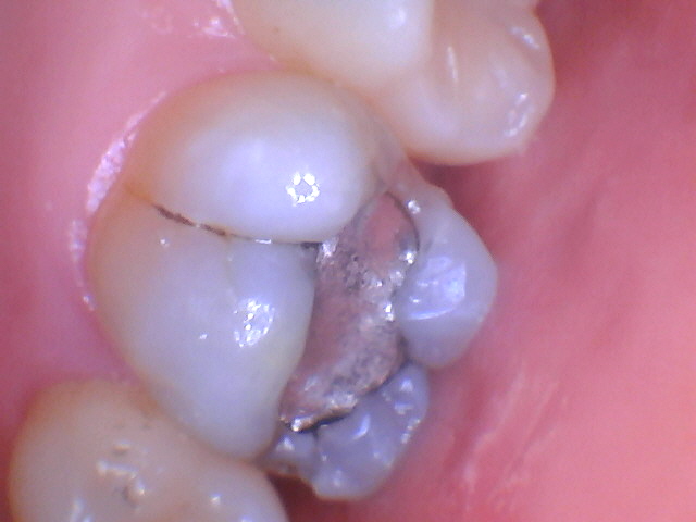 Smile gallery dentist image of dental patient upper arch peterson pre service