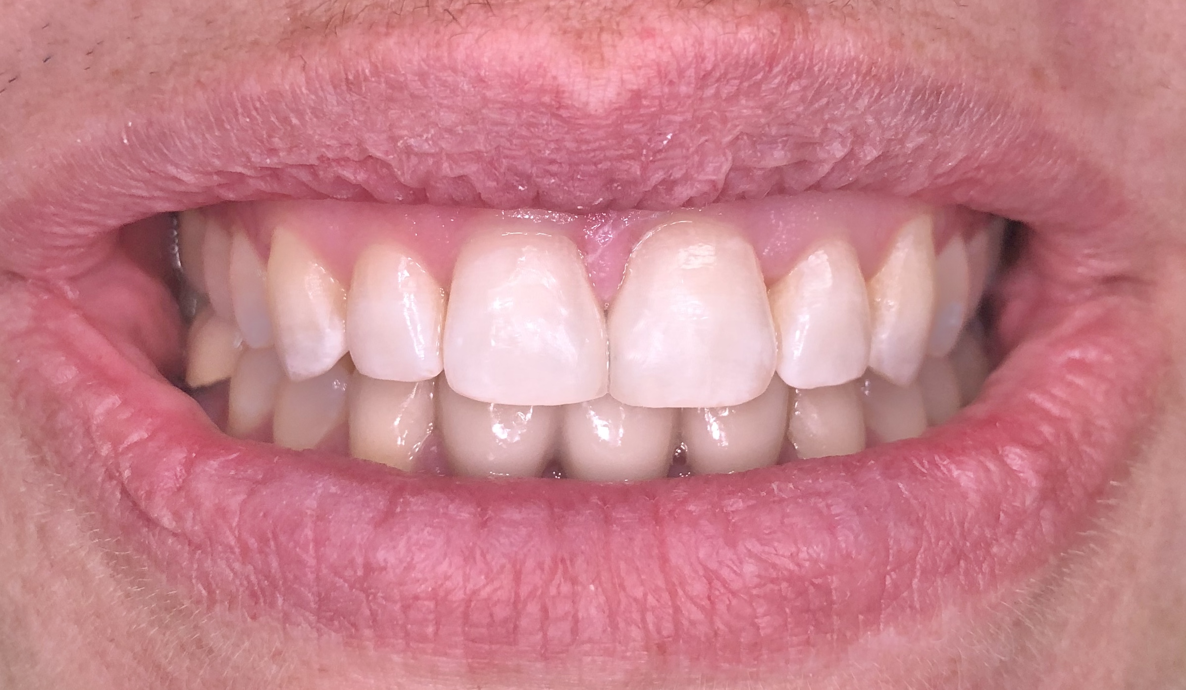 Smile gallery dentist image of dental patient veneers post service