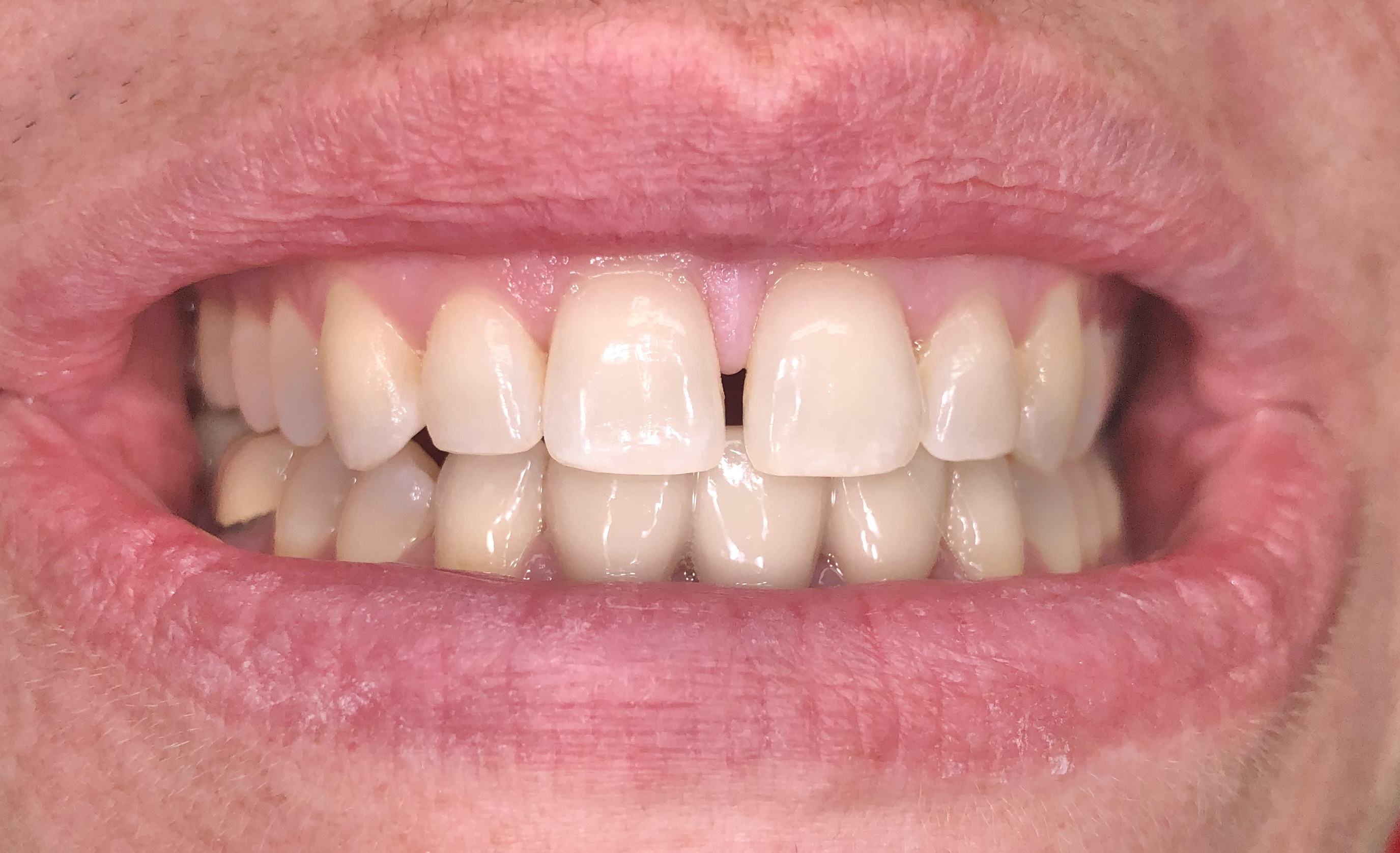 Smile gallery dentist image of dental patient veneers pre service