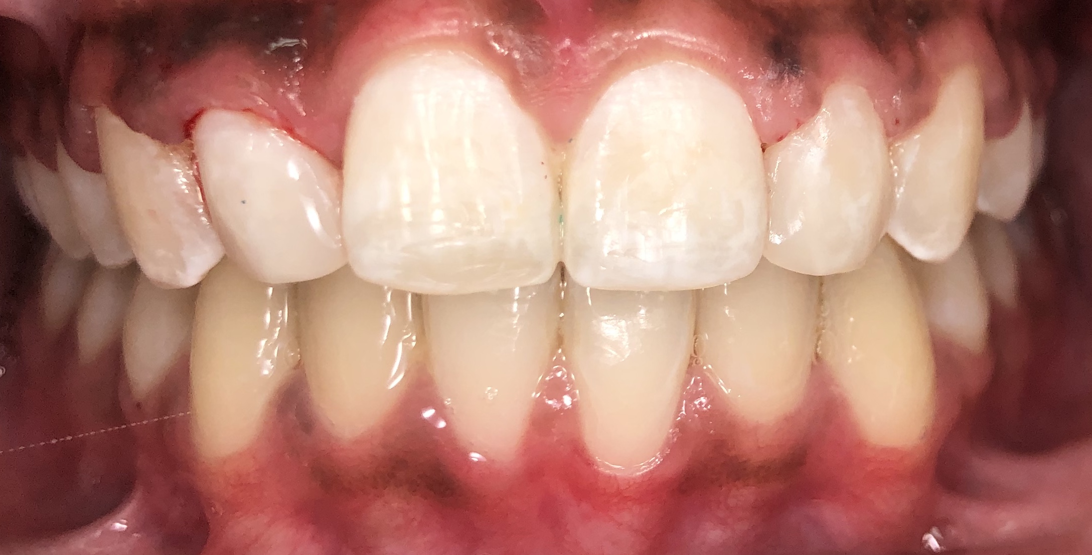 Smile gallery dentist image of dental patient crowns 7-10 eo post service