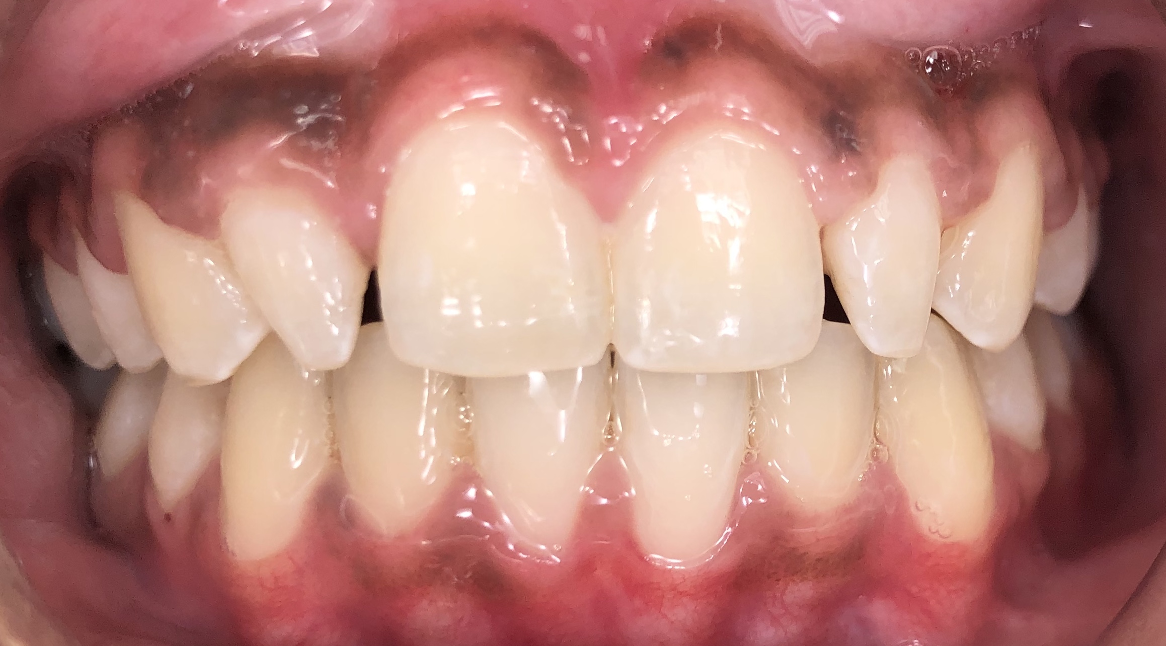 Smile gallery dentist image of crowns 7-10 eo pre service